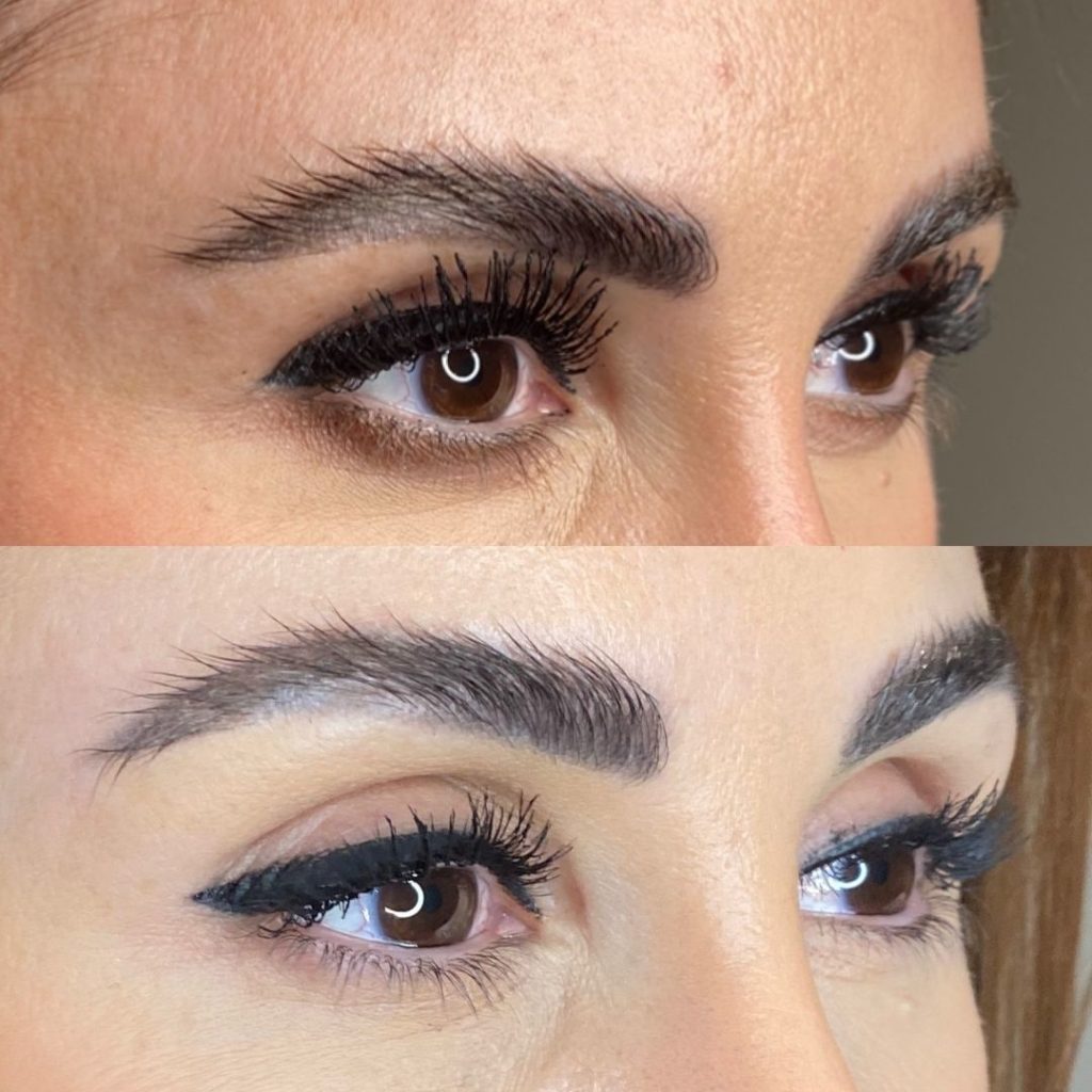 Fox Eye Thread Lift London | SAS Aesthetics