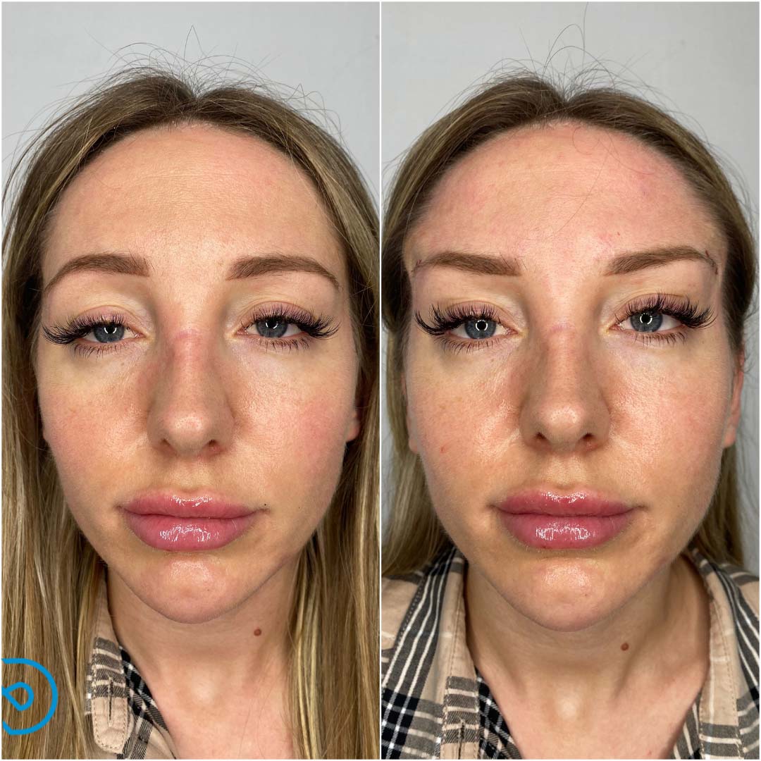 Fox Eye Thread Lifts In Chelsea | SAS Aesthetics