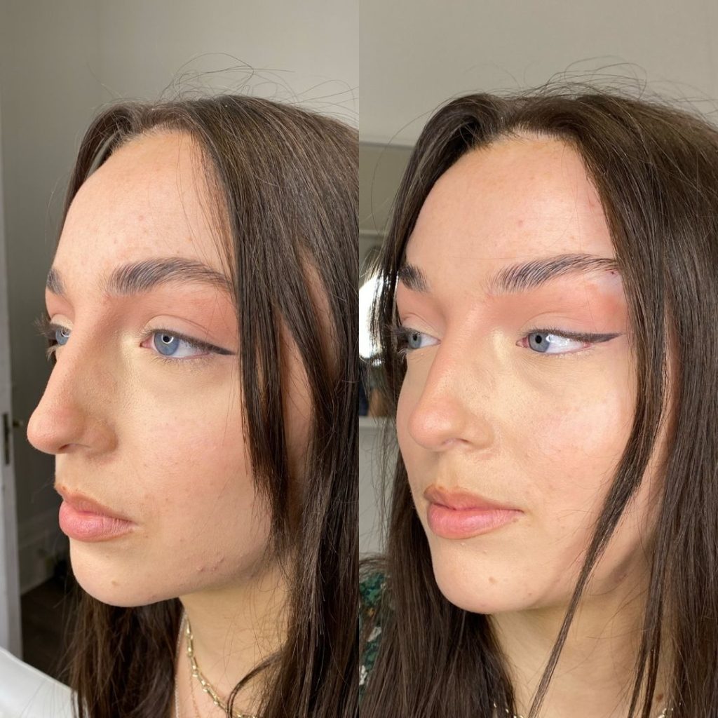 Fox Eye Thread Lifts in Chelsea SAS Aesthetics