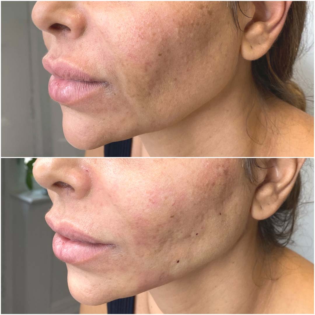 Lower Face Thread Lift London | SAS Aesthetics