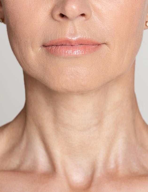 Jowl Treatments & Fillers London SAS Aesthetics