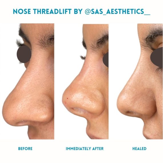 Nose Thread Lift SAS Aesthetics